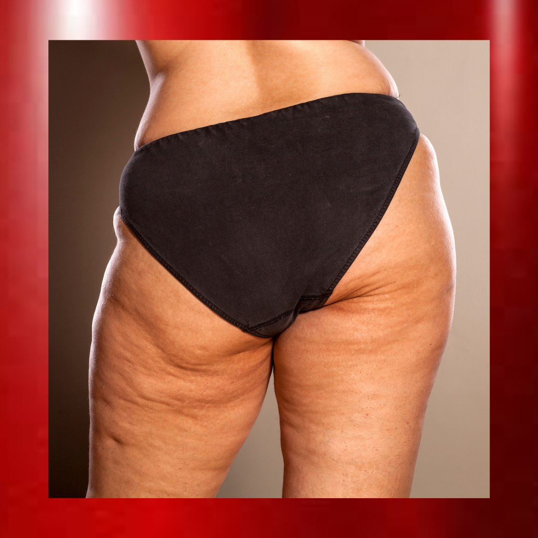 Cellulite reduction
