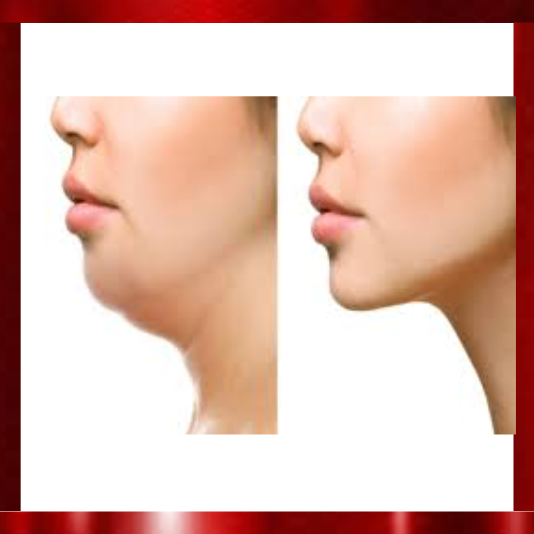 Chin Reduction Treatment