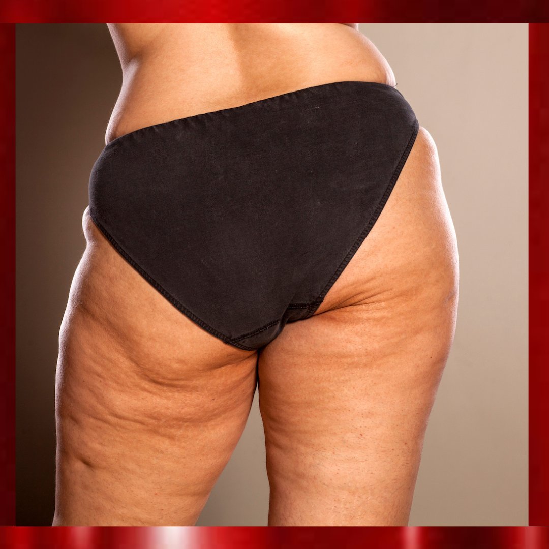 Cellulite Reduction