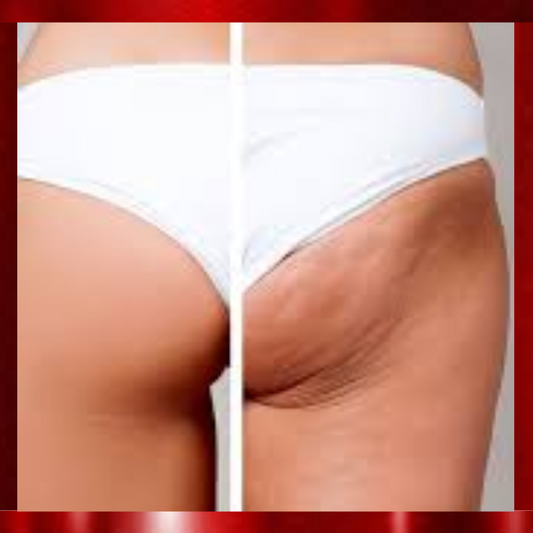 Columbian Cellulite Treatment