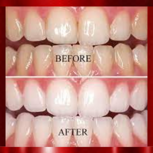 Teeth Whitening