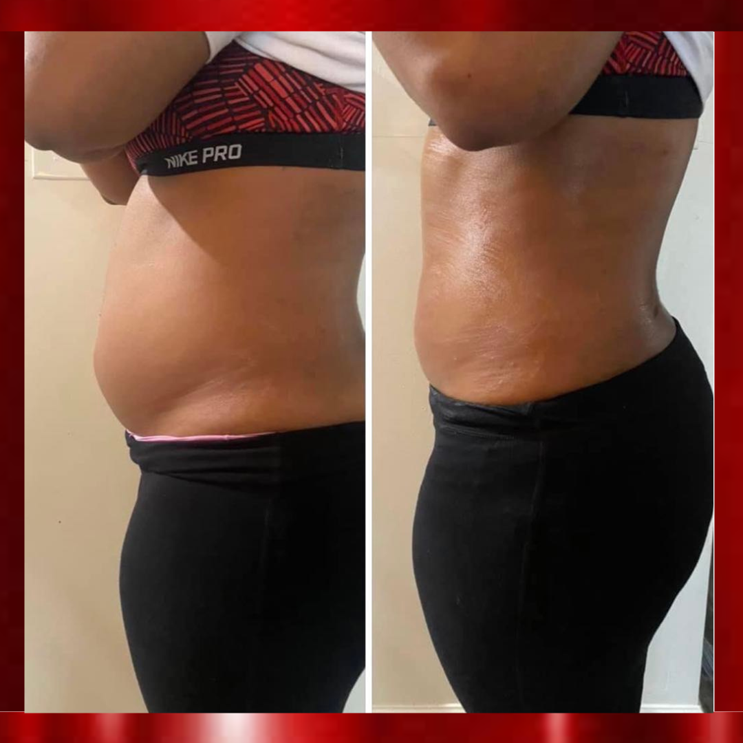 Fat Freezing